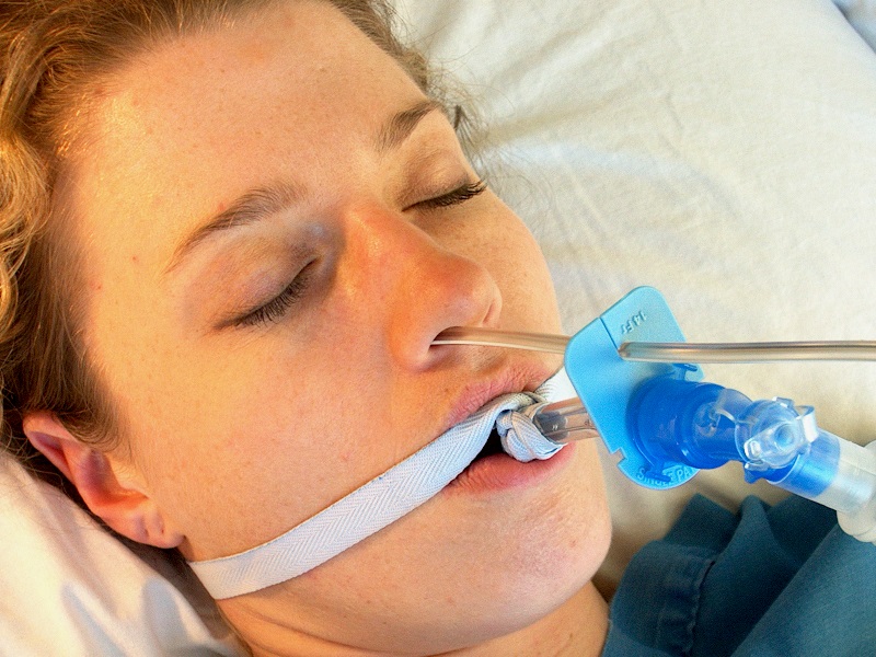 A woman with iritation due to her nasogastric tube as it is being held to the endotracheal tube by the TubeSafe tube holder